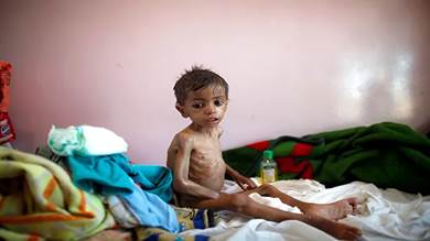 ​القنابل تتوقف في اليمن لكن الأطفال يواجهون الموت